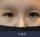 비절개 앞트임+…