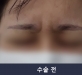미간신경차단 …