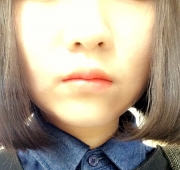 아큐스컬프 3일…