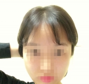 아큐스컬프 14…