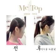 뒷통수 성형 다…