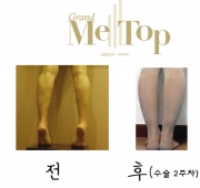종아리퇴축술 2…