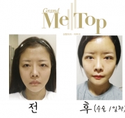 비절개 눈매교…